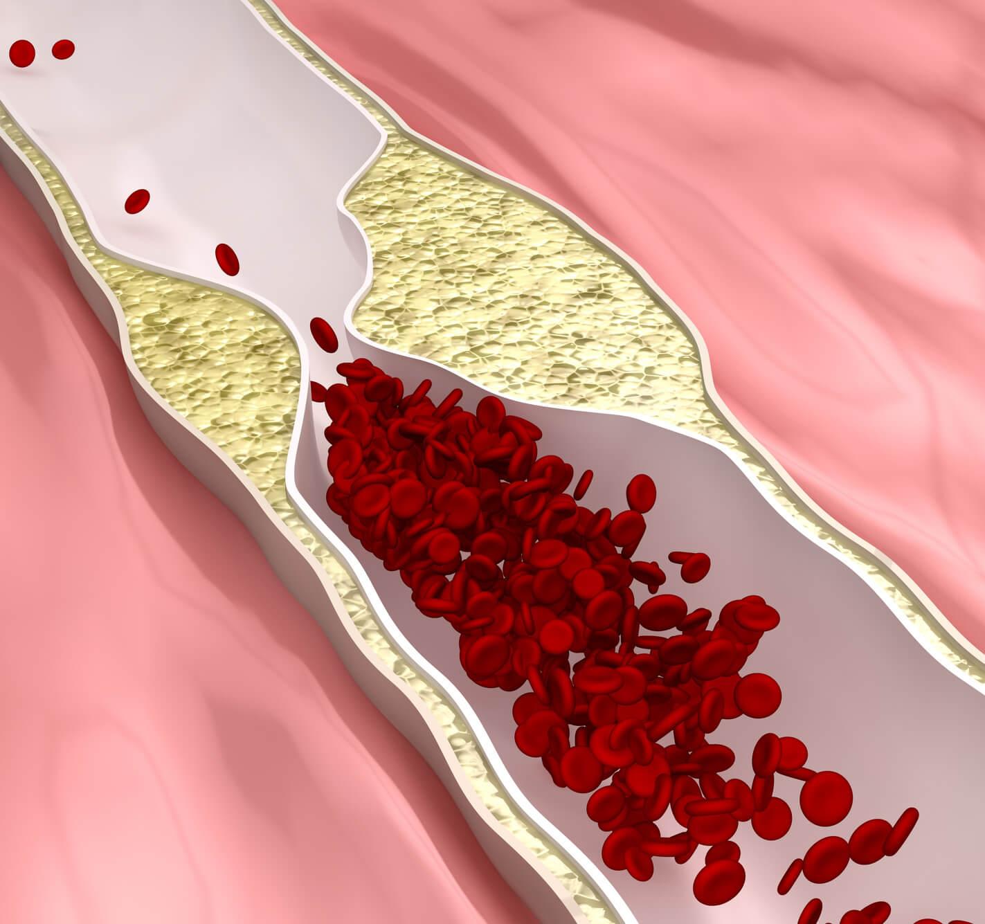 dyslipidemia