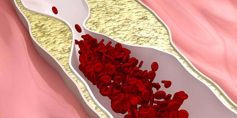 Hipercholesterolemia