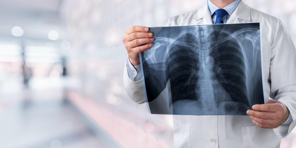 ropień płuc - zdjęcie przedstawia lekarza oglądającego zdjęcie rtg klatki piersiowej