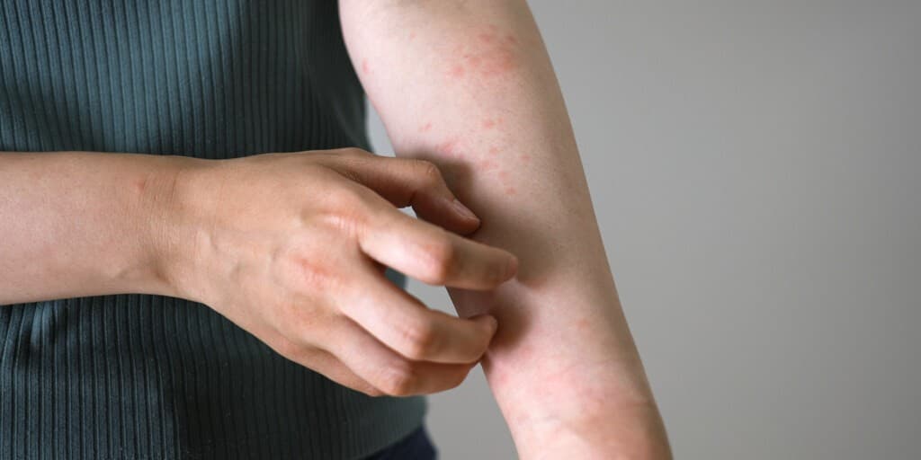 Alergia na proszek do prania