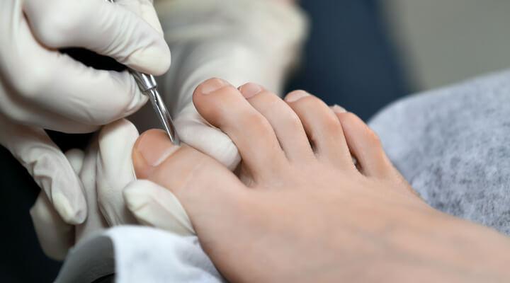 o czym świadczą żółte paznokcie u nóg