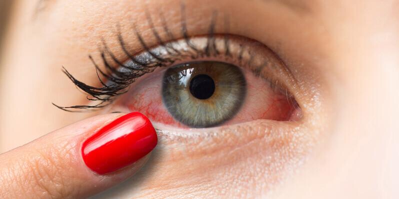 Przekrwione oczy - poznaj możliwe przyczyny. Zbliżenie na przekrwione oko.