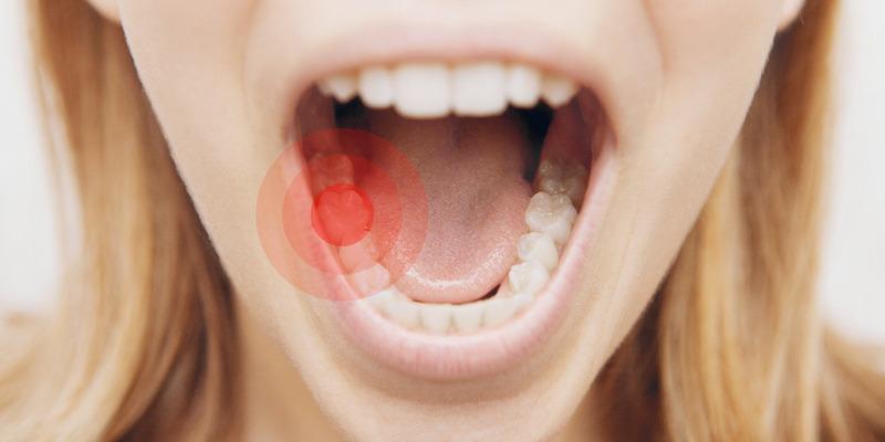 Zapalenie miazgi - objawy, metody uśmierzania bólu. Kobieta z otwartymi ustami, zbliżenie na bolącego zęba.